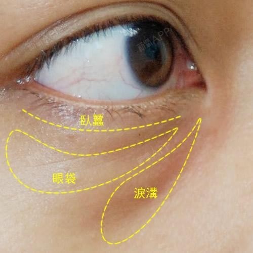 9595科普9797『眼袋』是指眼睛下睑部组织臃