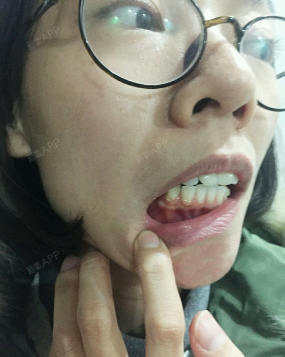 新牙套对我可真好戴上左边的3号牙上下都很疼我可以理解为牙齿在移动