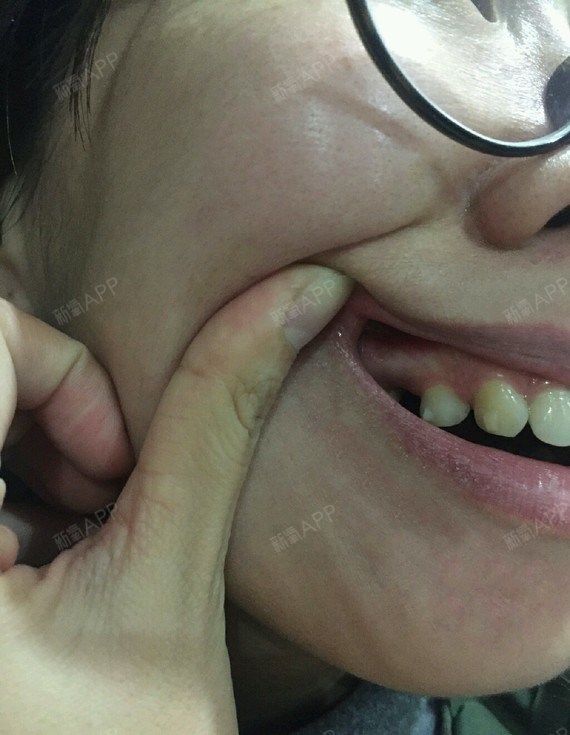 新牙套对我可真好戴上左边的3号牙上下都很疼我可以理解为牙齿在移动