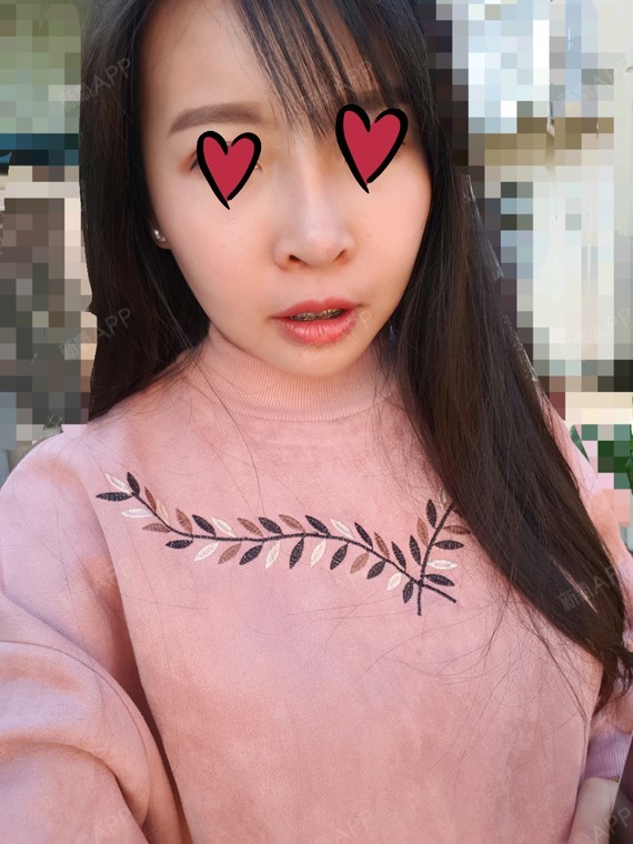 我爱胖达v-line瓜子脸手术第67天美丽日记