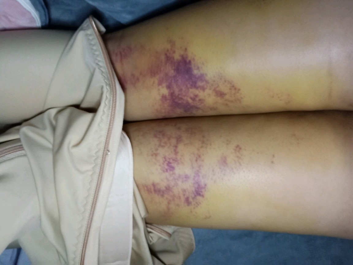 我2月21号做的大腿吸脂手术到今天还是很肿脚也肿了还有淤青我问医生