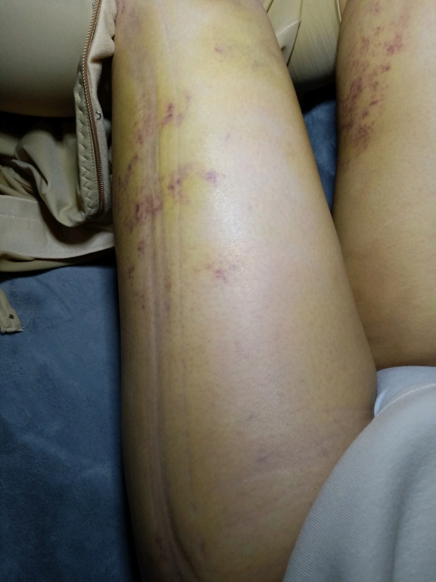 我2月21号做的大腿吸脂手术到今天还是很肿脚也肿了还有淤青我问医生
