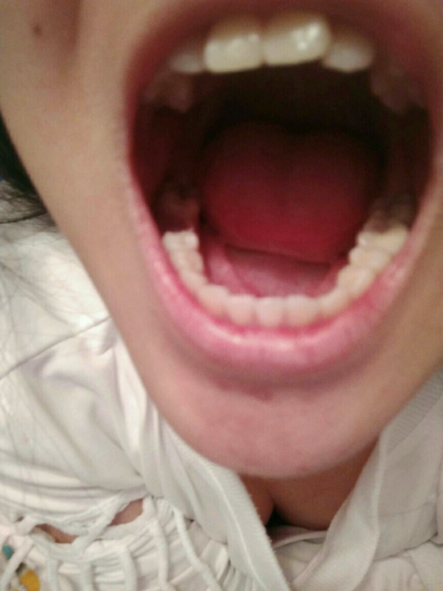 蛀牙大牙齿上有黑黑的怎么办