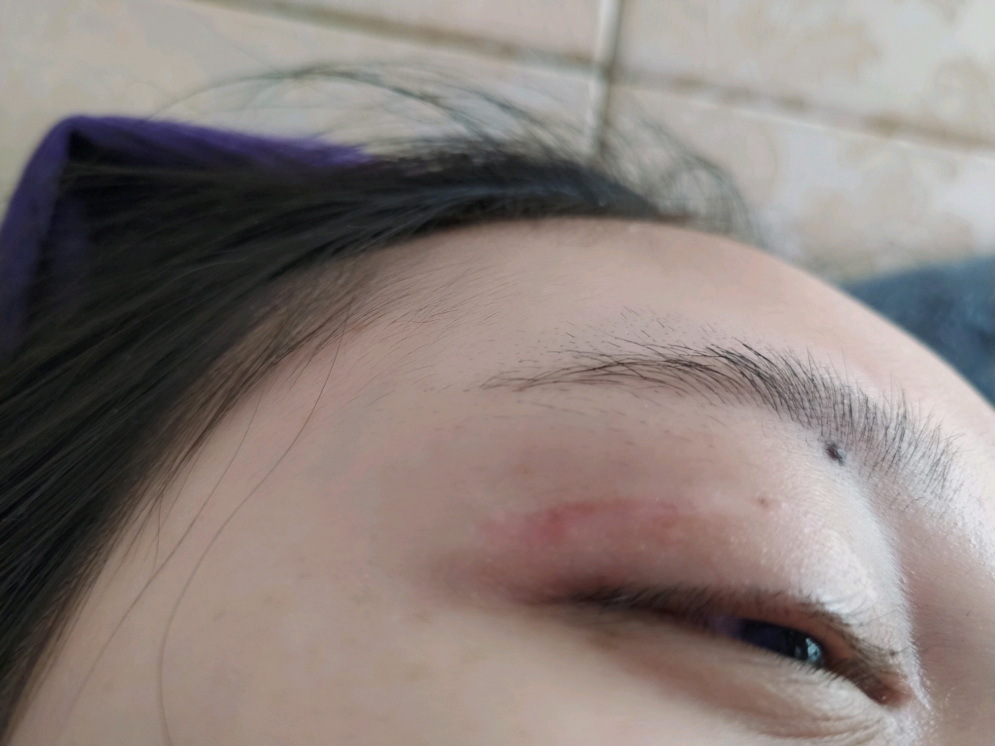 6好做的第一次双眼皮加开眼角,到现在眼角疤痕增生还是这样,而且医生