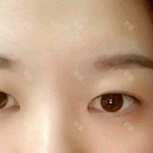 如何测试上睑肌无力 我这是肌无力吗 新氧美容整形