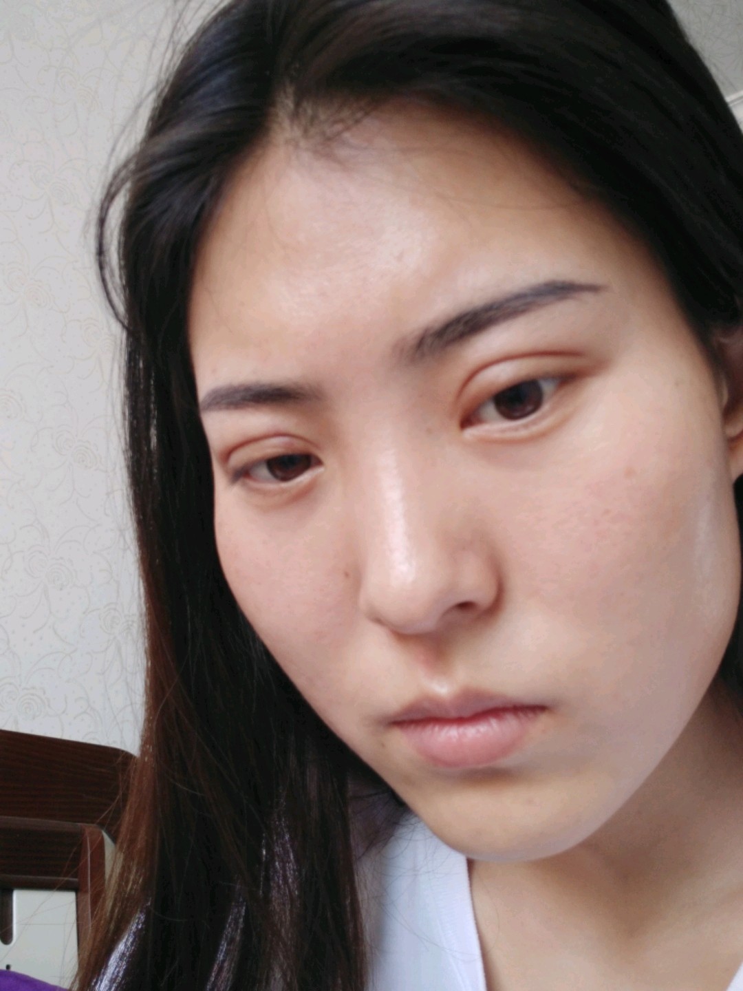 纳米无痕双眼皮第二十一天想问一下是肿胀还是肉条是不是做的太宽了