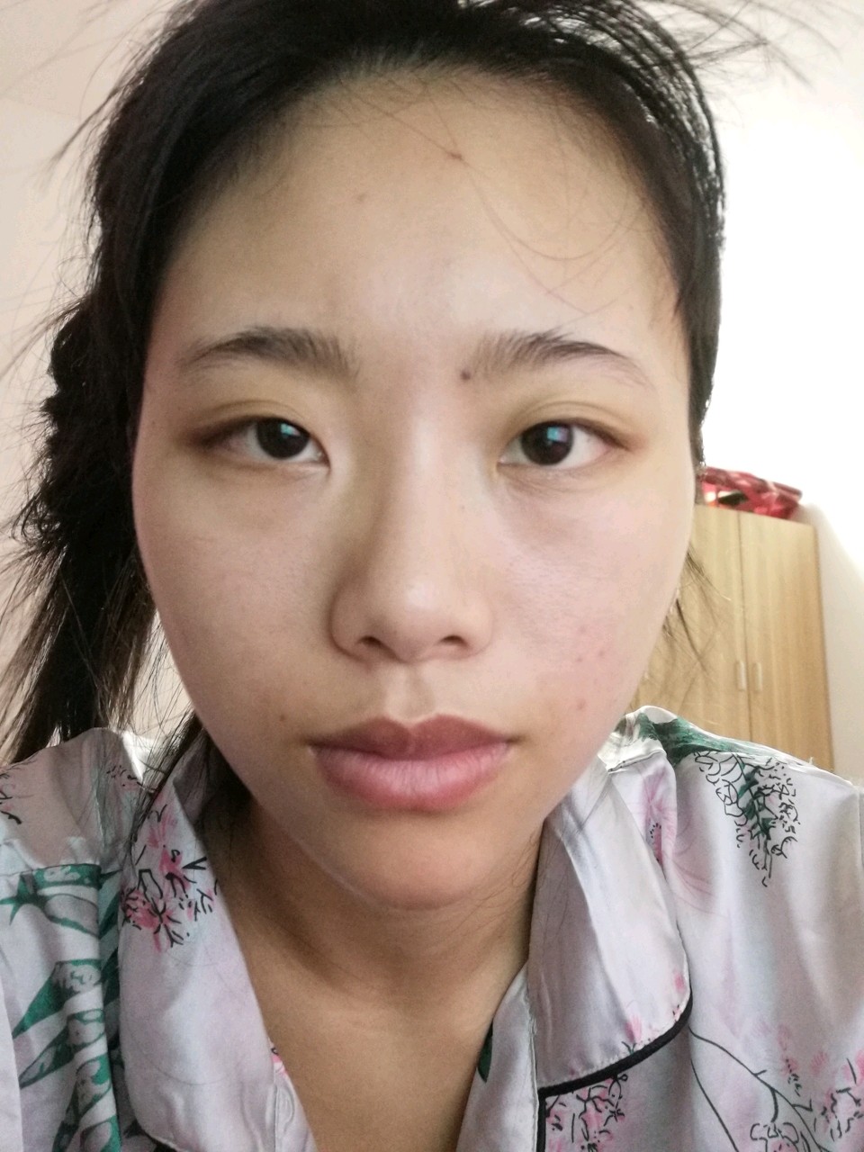 内眦赘皮太严重啦把眼头包住了显得双眼间距太宽了我这种做开内眼角能