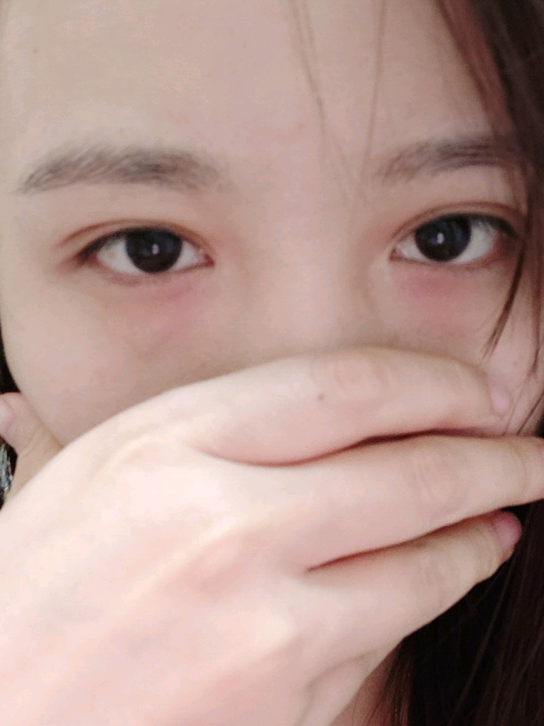 全切双眼皮后闭眼疤痕宽深无神当时做的平行的能修复成窄的那种开扇双