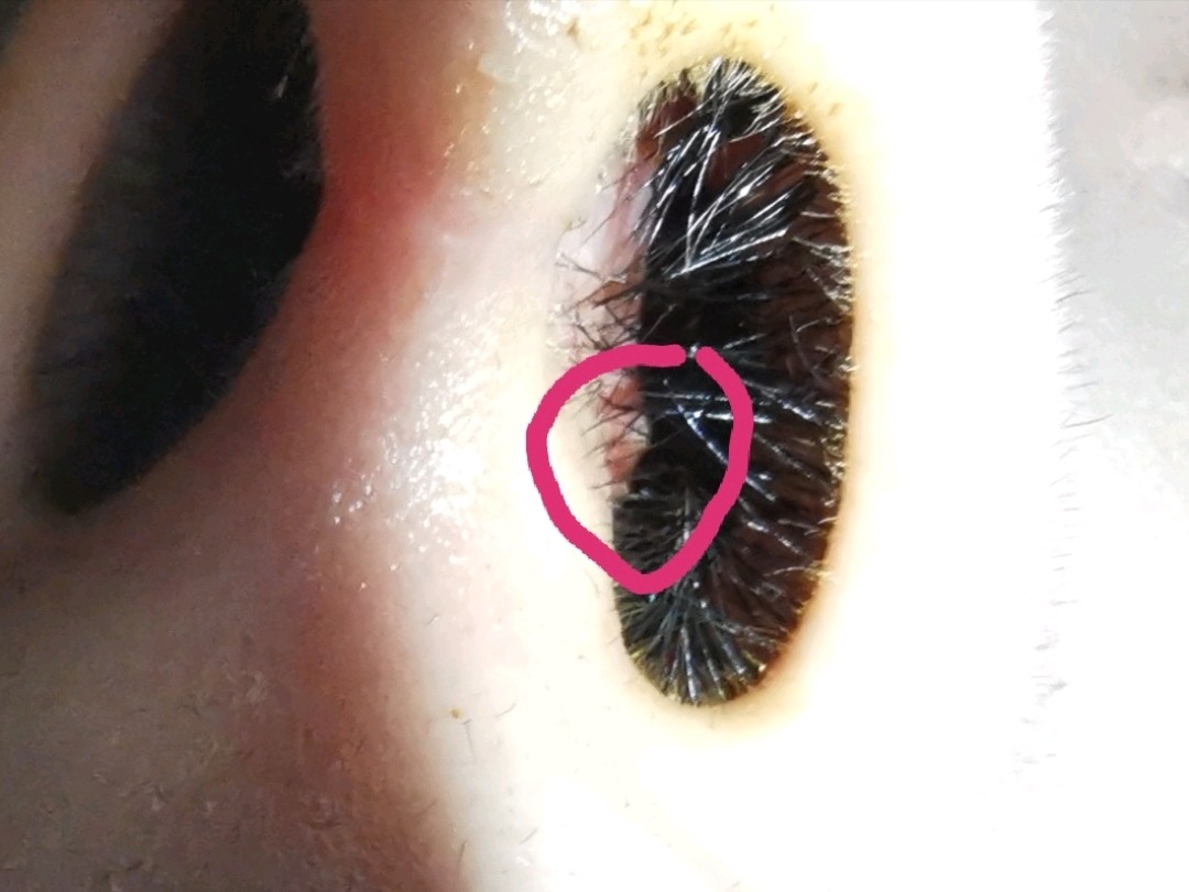 膨体耳软骨鼻部多项两个月了 鼻孔里面有_新氧-专业医美服务平台