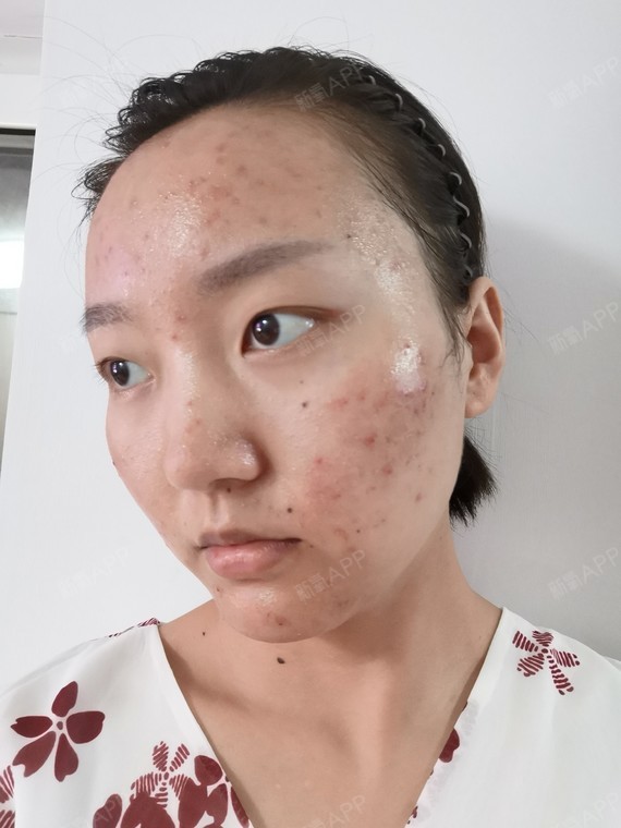 果酸2周,针清一周.除了个别痘痘爆出来,其他恢复很_圈子-新氧美容整形