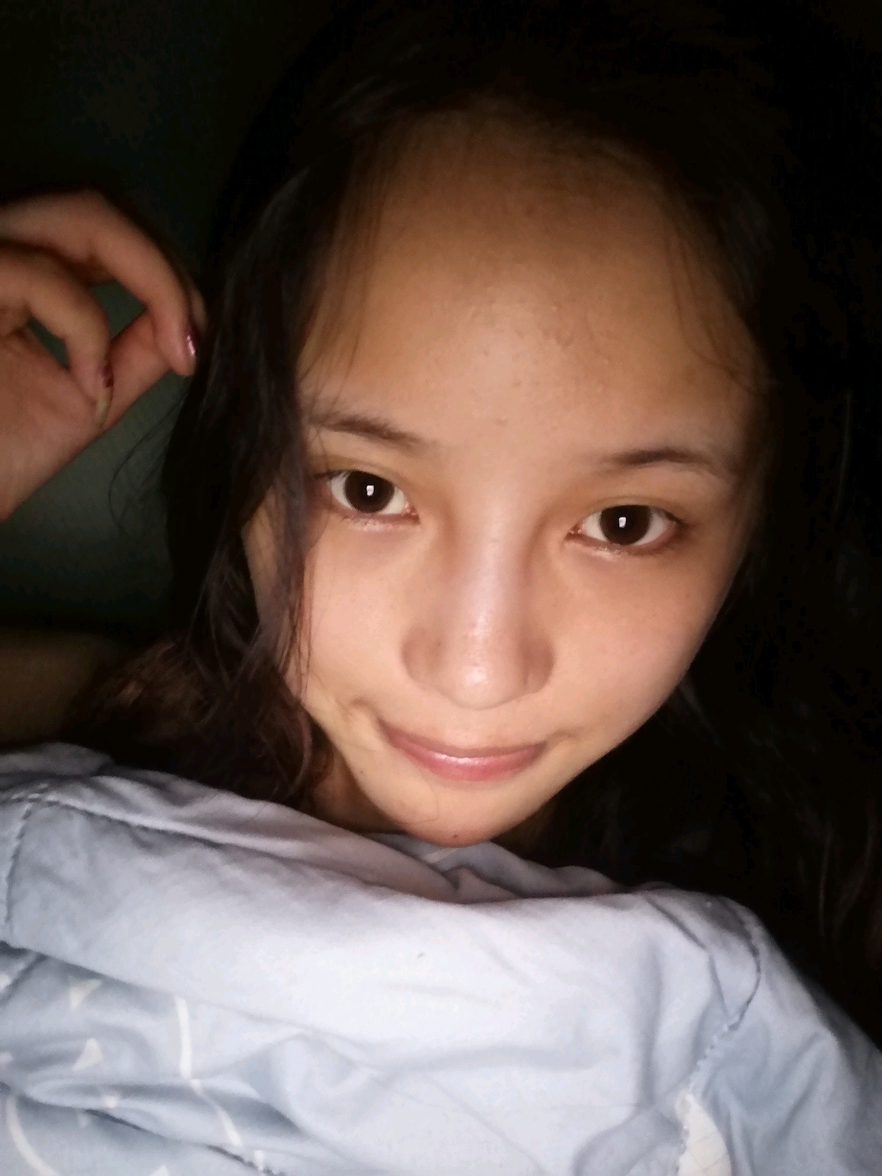 鼻子打玻尿酸到现在一年了发现变宽以后也不敢去补了就一直没补当时