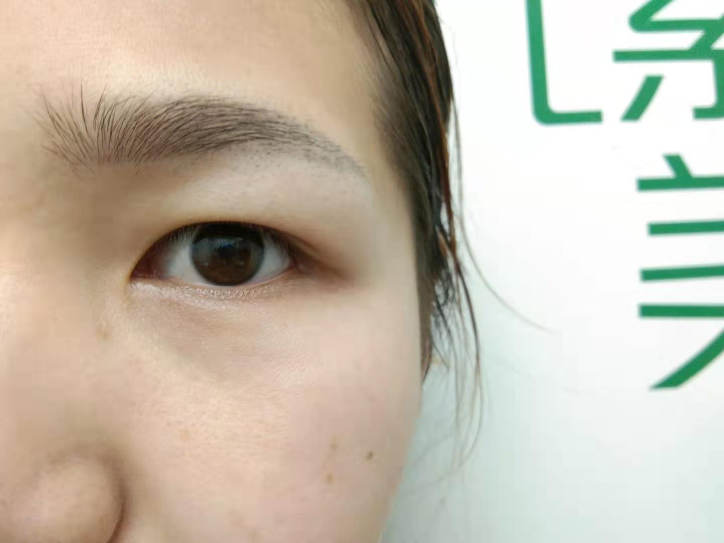 郑州元素美学整形眼部综合怎么样_恢复过程_效果如何_大头小猫咪整形