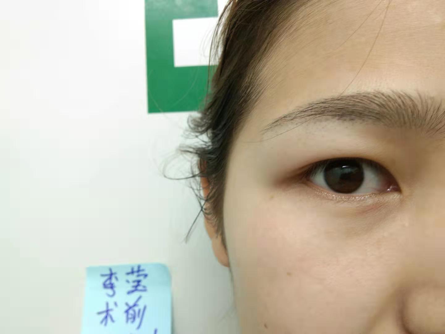 郑州元素美学整形眼部综合怎么样_恢复过程_效果如何_大头小猫咪整形