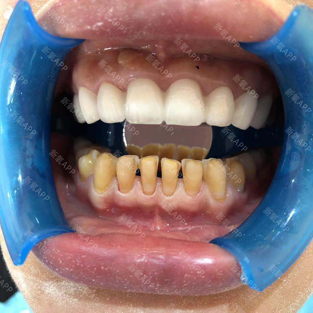 沈阳和平京都医美医疗美容门诊部 树脂贴面怎么样_恢复过程_效果如何