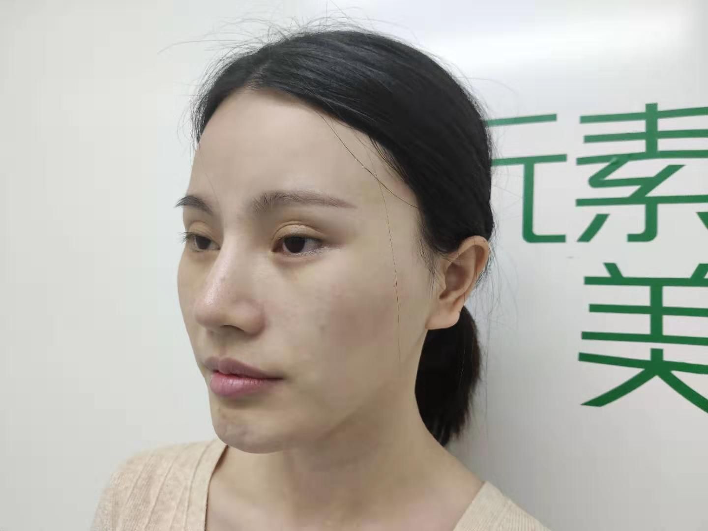 郑州元素美学整形下眼下至术怎么样_恢复过程_效果如何_金色满满整形