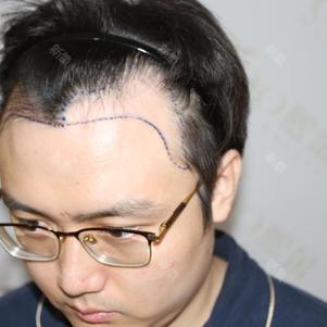 种植发际线500单位|专利植发|女性产后脱发|头顶稀疏|头发加密种植