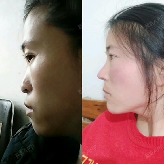 跟我之前蛮像的,我做了鼻子垫了鼻基底后好多了