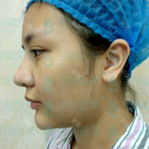 太原美白针好不好_效果图_氧气uif6f40美白针术后第13天_新氧美容整形