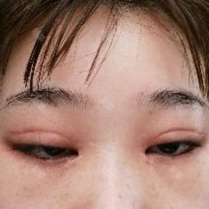 双眼皮是否割失败了 三个月了