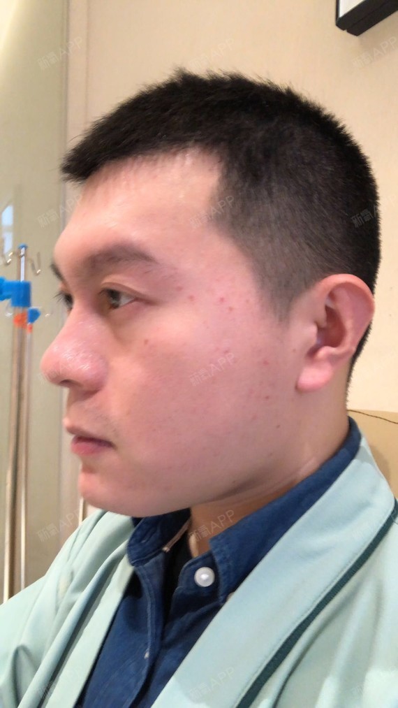 光子嫩肤项目术后第22天