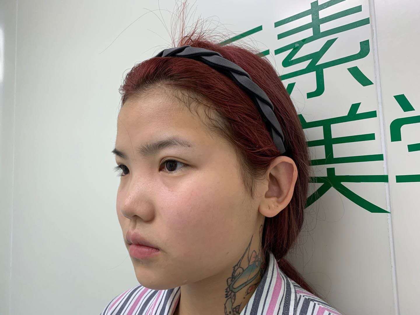 郑州元素美学整形鼻综合怎么样_恢复过程_效果如何_6月的整形日记6.