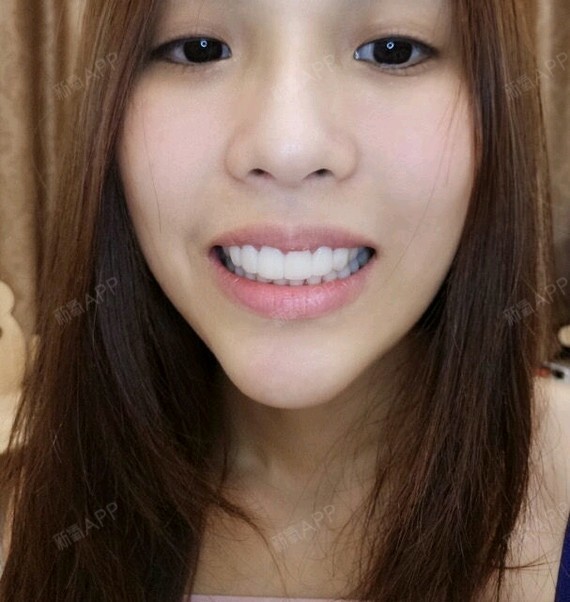 我的牙齿很整齐但是一直黄黄的,回顾以前的照片,都不敢开口大笑,黄牙