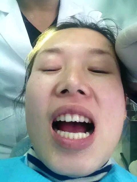 门牙是经常嗑瓜子   医生说是瓜子牙～ 一直觉得很影响    门牙在最