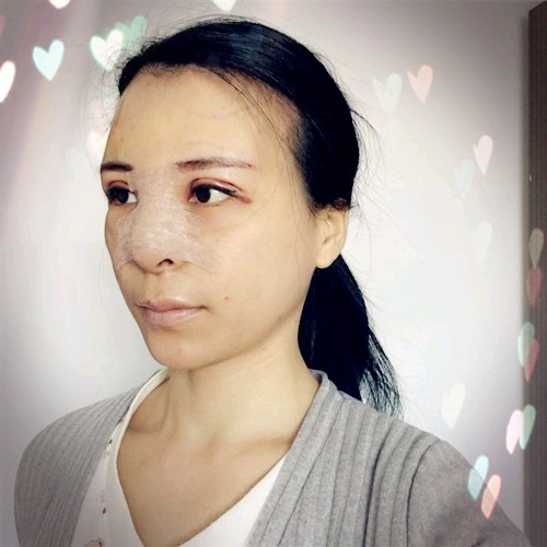 内切去眼袋怎么样_恢复过程_效果如何_懿火整