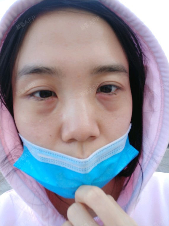 北京叶美人医疗美容医院 眶隔脂肪释放术后一周