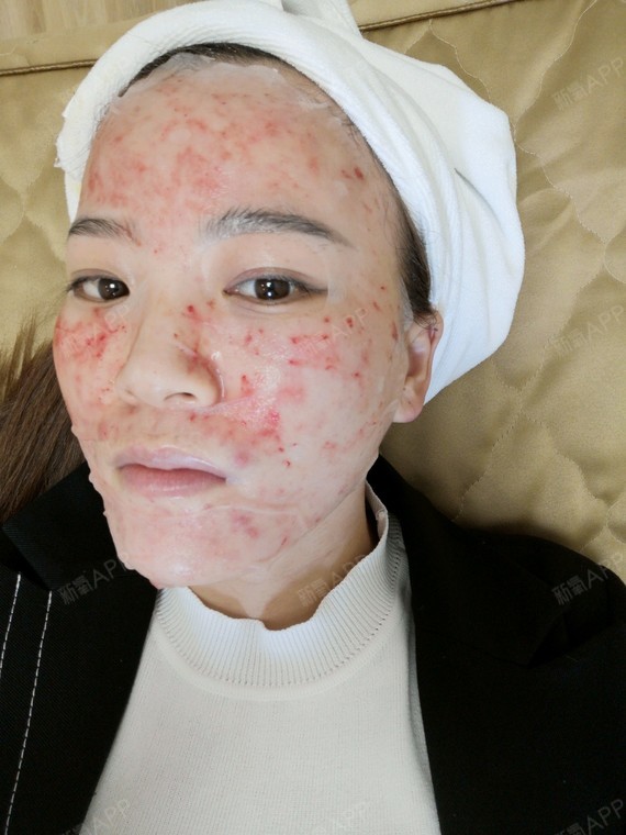 做完水光补水第一天