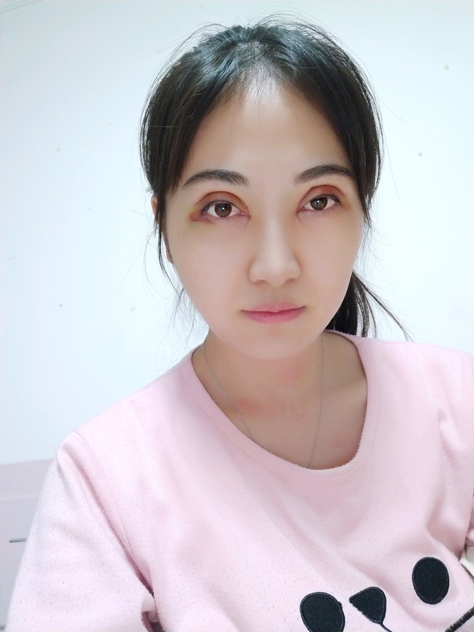 古塔区博美雅医疗美容门诊部眼部综合怎么样_恢复过程_效果如何