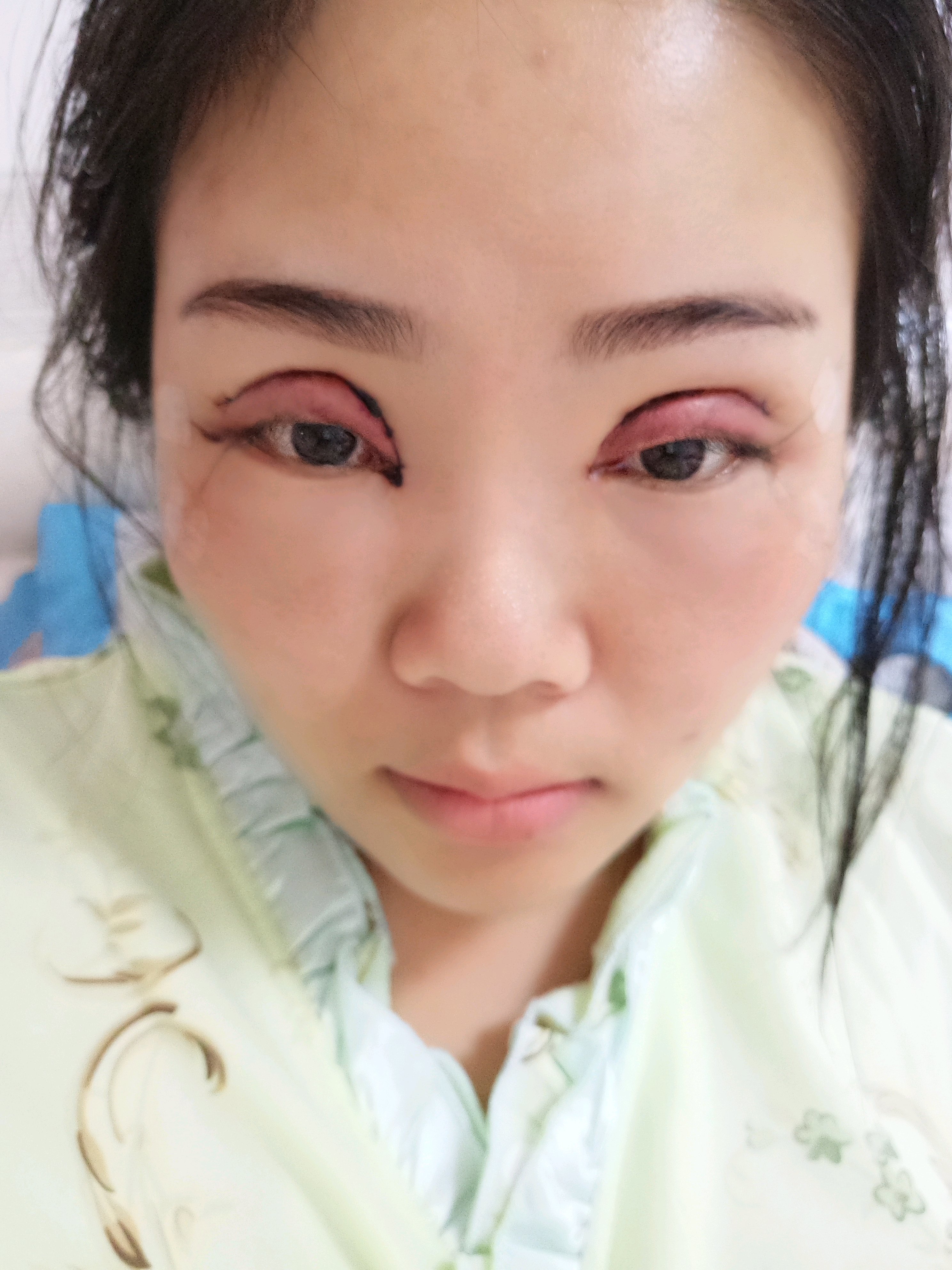 开外眼角怎么样?_欢欢丶美丽日记-新氧美容整形