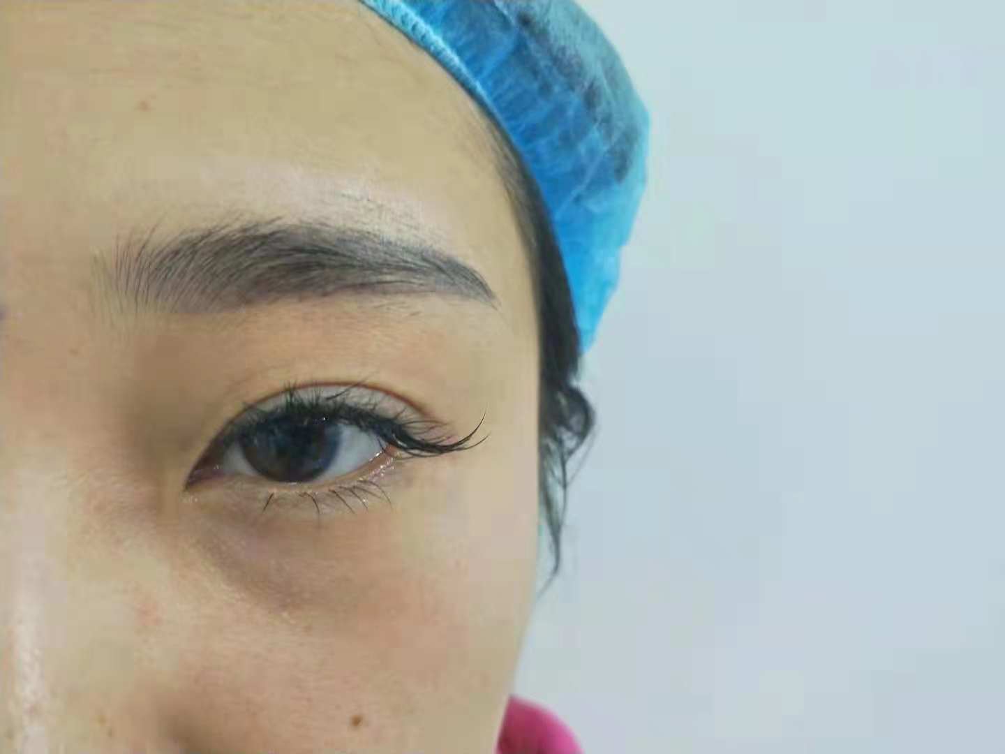 郑州元素美学整形眼部综合怎么样_恢复过程_效果如何_静静地等待你的