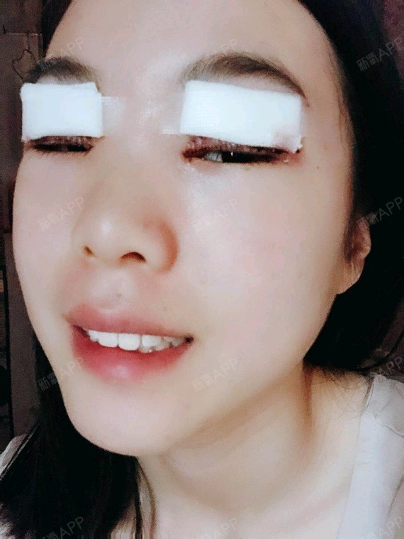 我是有点内双的,看起来眼睛挺小的,我特别想去割双眼_圈子-新氧美容