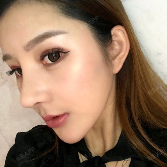 南京缪斯整形医院鼻基底第30天今天去做的假体垫鼻基底分享一下感受给