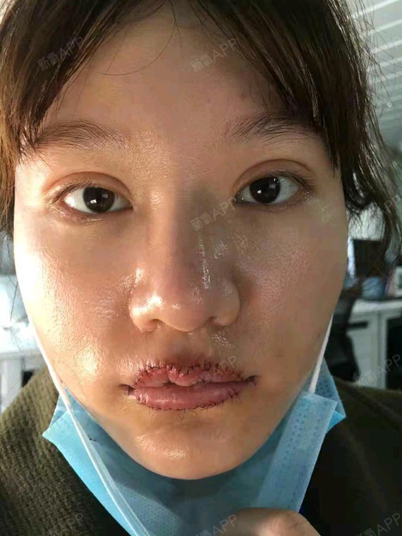 浩然妞妞唇部综合第0天美丽日记