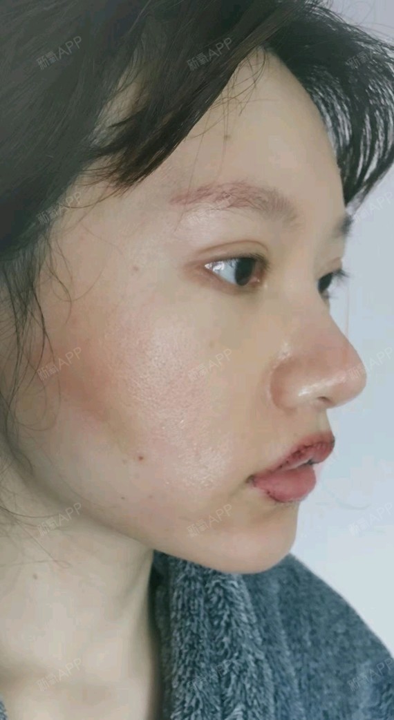 74上唇薄唇改厚 上唇m唇 下唇薄唇改厚74术后第3天_圈子-新氧美容