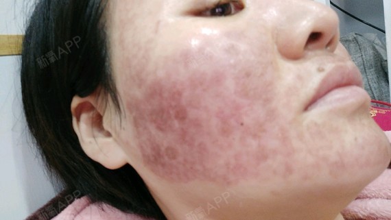 点阵激光