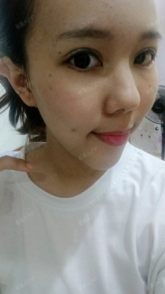 新氧- 胡龙龙 | 眼部 | 术后当自强 | 深圳同城 | 惠州同城 | 下眼睑