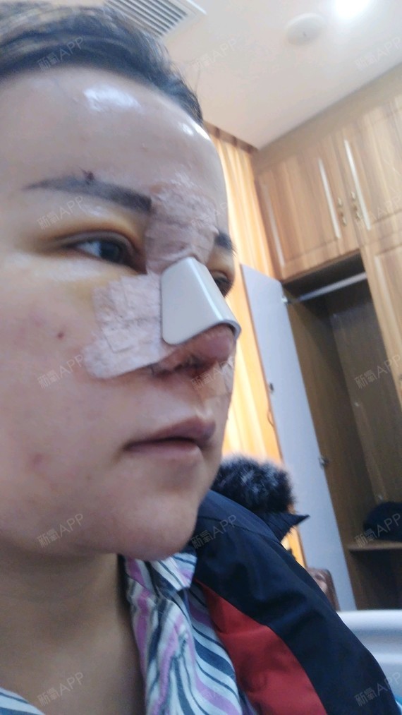 术后4天了请大家忽略我油光锃亮的大脑门毕竟还有好几天不能洗澡洗脸