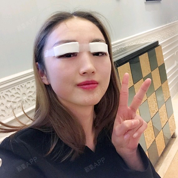 定点双眼皮