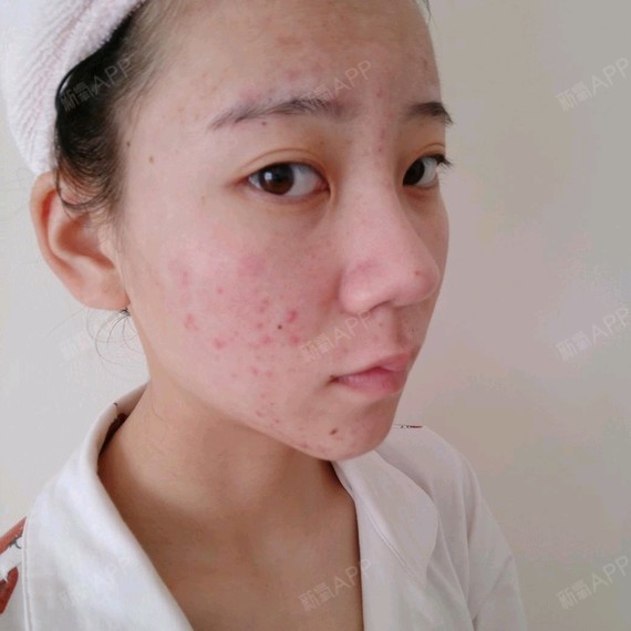 单身男女激光点痣第7天美丽日记