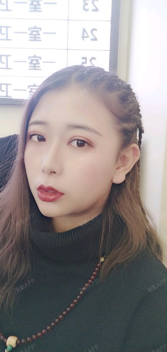 西安开外眼角好不好_效果图_氧气xxwk2开外眼角术后第80天_新氧美容