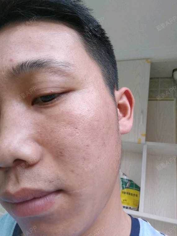 点阵激光好不好_效果图_氧气yl5he点阵激光术后第9天_新氧美容整形