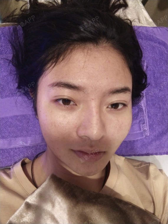 范2大师莹莹氏水光针第47天美丽日记