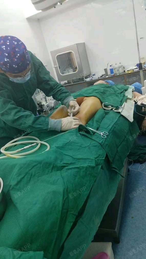 过程丰胸手术隆胸手术前后图片隆胸手术隆胸手术过程实拍隆胸手术图片