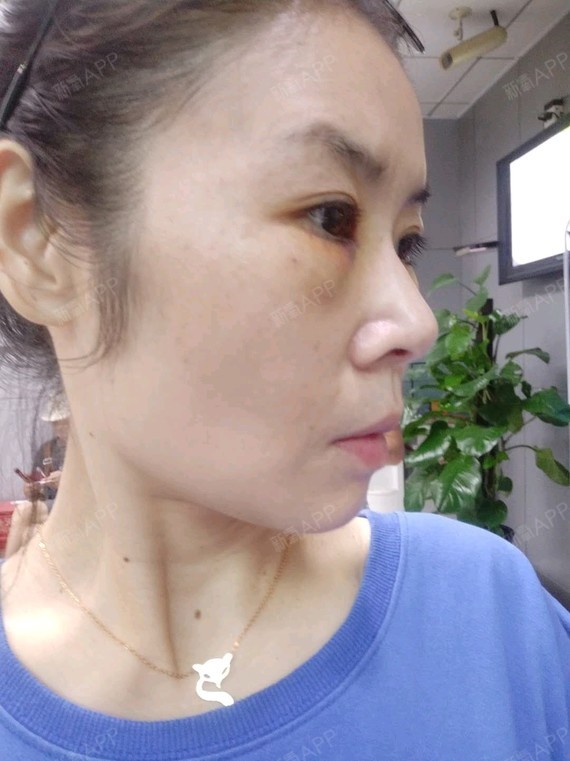 做了眼袋泪沟术后第三天,只是第一天的时候眼睛肿胀的_圈子-新氧美容