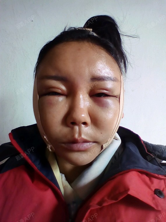今天是术后第三天了,脸部比先前肿胀的更厉害.