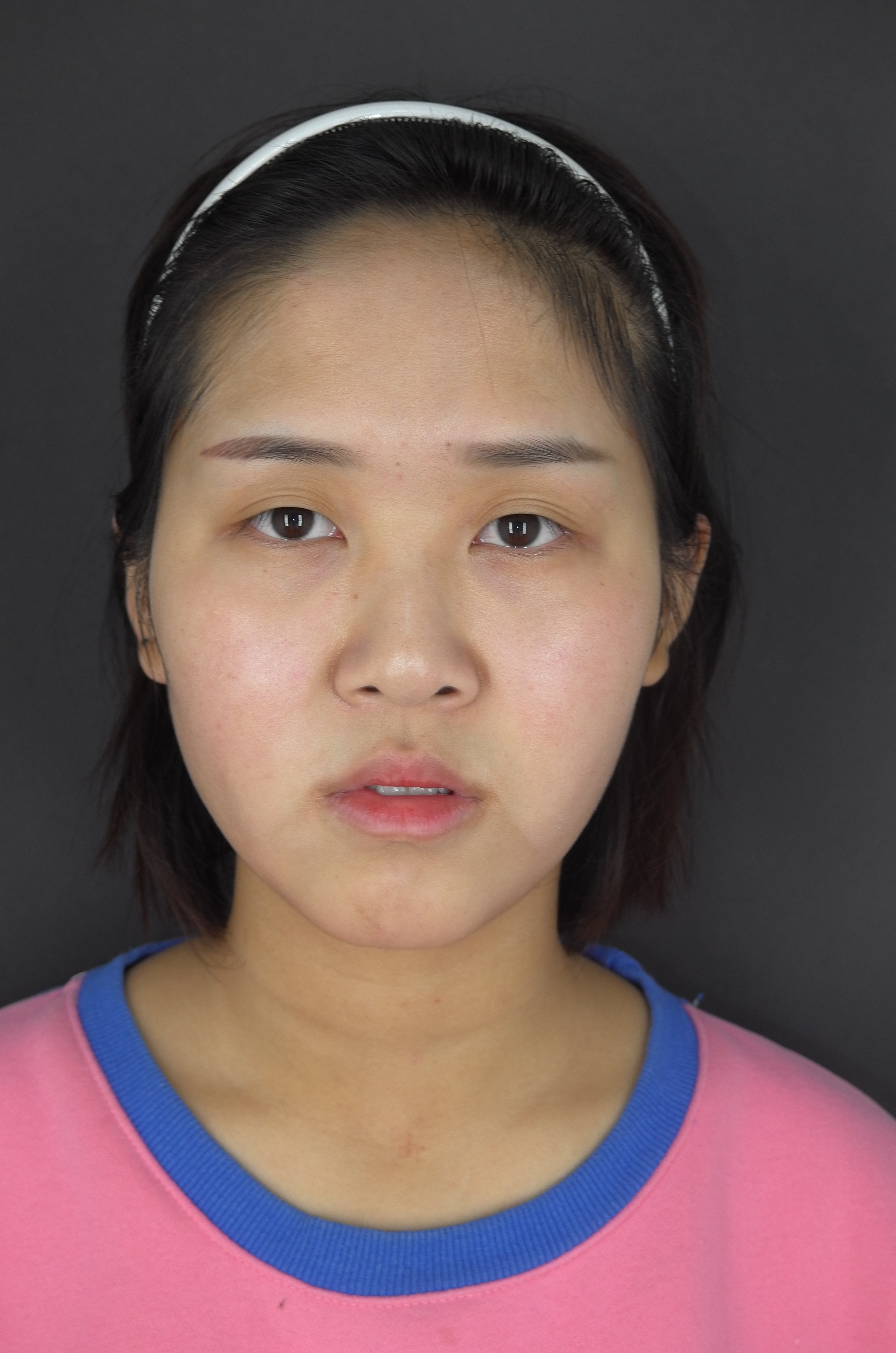 现在双眼皮半年了.我觉得由宽到窄是有一个过程.