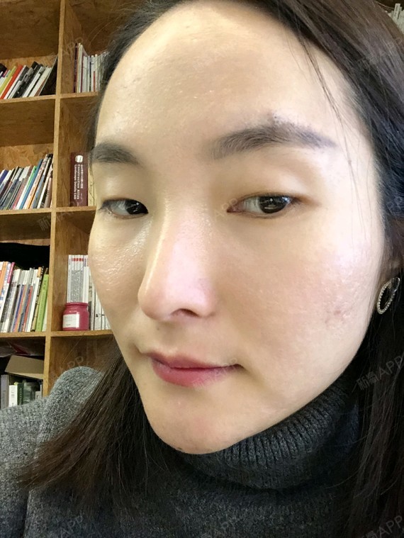 今天是做完黄金微针第十八天,脸上的变化真的让我很开_圈子-新氧美容